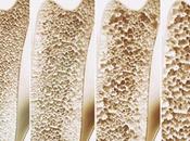 Osteoporosis: ¿Cómo vivir ella?