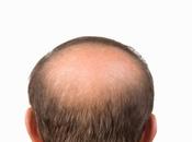 ¿Cómo prevenir alopecia androgenética? Natura Estilo