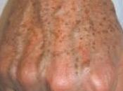 Eliminemos manchas edad