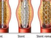 Colocación stent carótida
