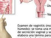 Impacto gravedad vaginosis bacteriana