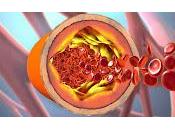 Enfermedades Neurodegenerativas relacionadas Colesterol