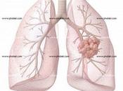 Vacuna para cáncer pulmon.