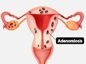 Recomendaciones para Tratar Adenomiosis