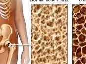 Osteoporosis. Indice FRAX