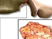 ¿Sabes osteosarcoma?