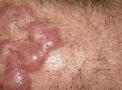 Granuloma facial cuero cabelludo