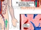 número reducido pacientes lesiones traumáticas embolia pulmonar tienen trombosis venosa profunda pelvis extremidad inferior