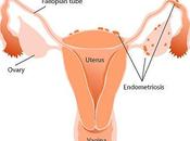 Endometriosis