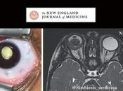 Caso clínico retinoblastoma