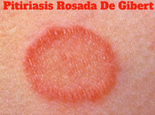 Pitiriasis rosada Gibert, experiencia