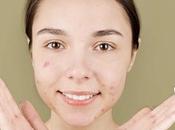 Estos activos tratamientos eficaces contra acné según doctora experta combatirlo