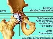 Síntomas artrosis cadera