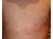 urticaria