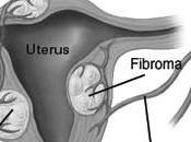 fibromas necesita saber