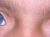 'Heterocromía iridum' ojos diferente color misma persona (Galería imágenes)