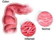 Alimentos evitar aqueja síndrome intestino irritable