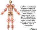 Artritis reumatoide fisioterapia terve lucha canaria