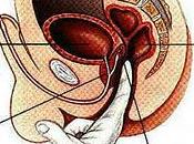 cáncer próstata tiene causas multifactoriales: Mauricio Cantellano