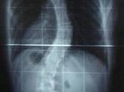 ¿Cuándo está recomendada cirugía para pacientes escoliosis?