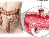 ¿Qué Diverticulosis?