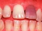 Antibiótico decolora dientes