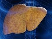 Claves para prevención tratamiento enfermedad hígado graso, según estudio