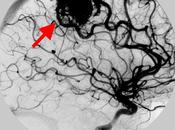 Malformaciones arteriovenosas cerebrales, ¿qué hacer?