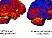 Tamaño cerebro para predecir enfermedad Alzheimer