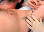 Botox para transpiración