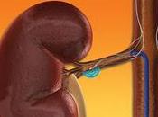 Denervacion Renal Mejora Hipertension Arterial