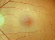 Edema macular.