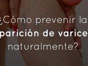 ¿Cómo prevenir aparición varices naturalmente?