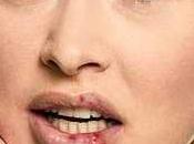 Como curar herpes labial rapidamente