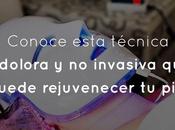 Conoce esta técnica indolora invasiva puede rejuvenecer piel