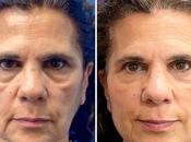 Rejuvenecimiento facial bioestimuladores Clínica Menorca: belleza natural excesos