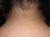 Acantosis Nigricans