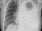Avidad torácica izquierda, derrame pleural aproximadamente origen determinar