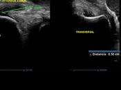 Epicondilitis lateral rotura intrasustancia tendón extensor común