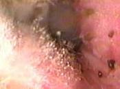 Otomicosis