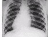 Situs Inversus