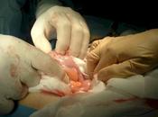 demora apendicectomías implicaría riesgos