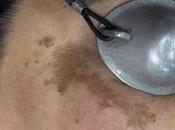 Dra. Janeth Arévalo analiza factores agravan melasma alimentos influyen evolución