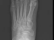 Fractura avulsión tuberosidad metatarsiano edema asociado