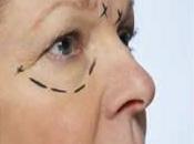 Blefaroplastia