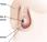 Quistes testiculares